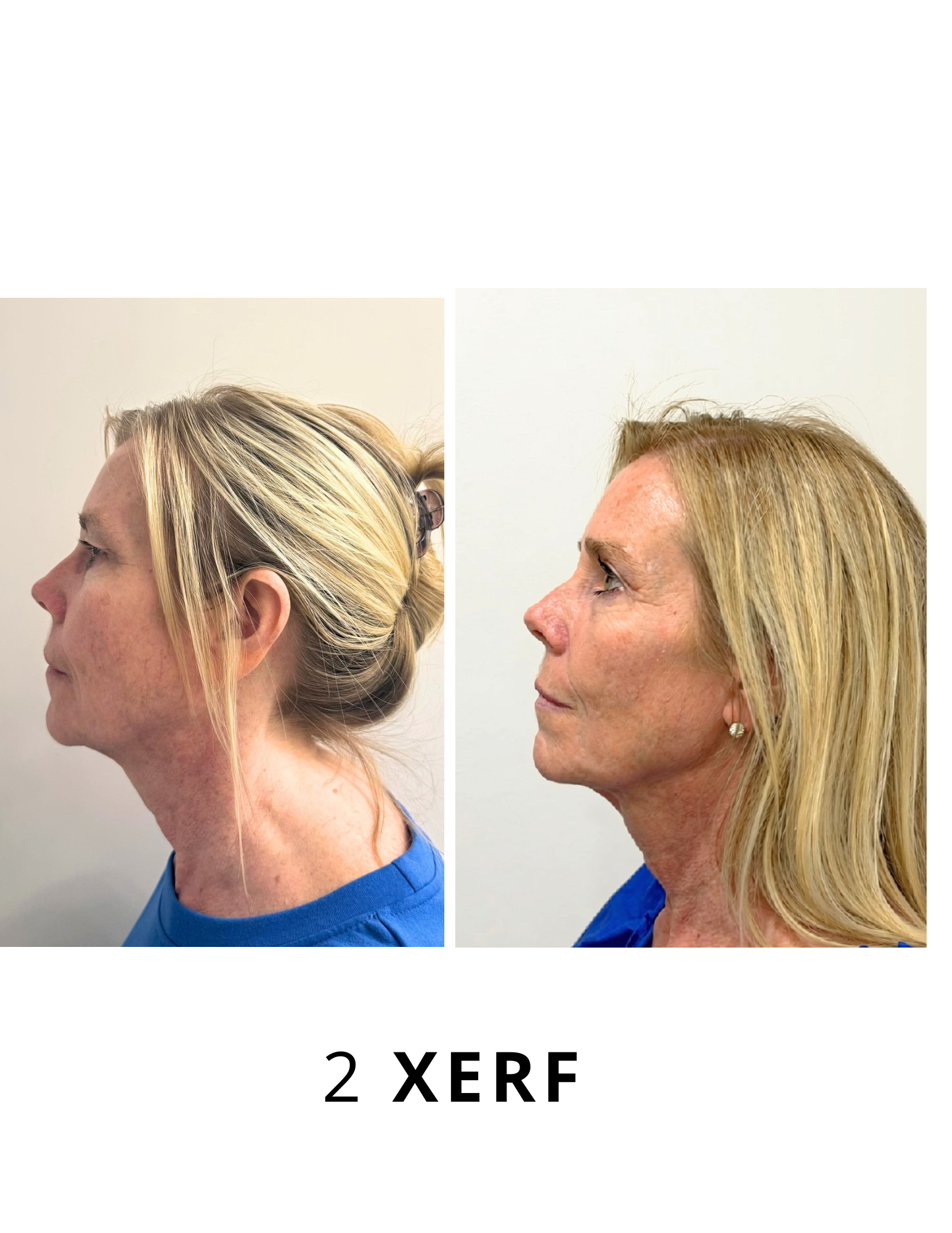 Before and after
