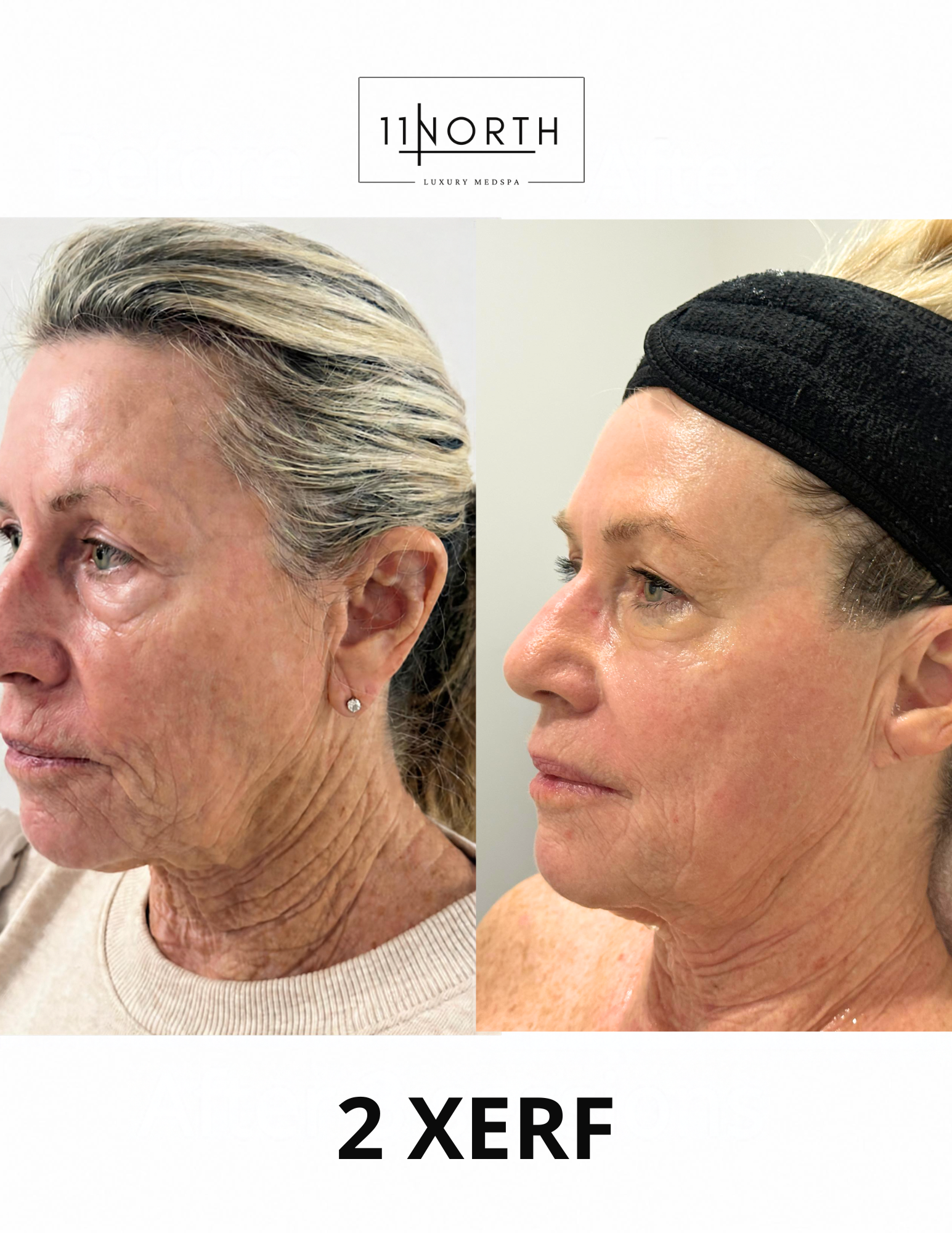 Before and after
