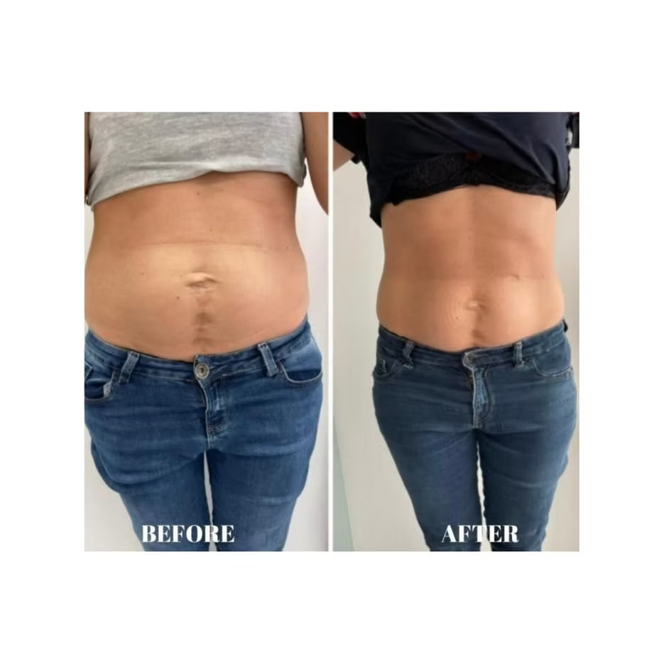 Before and after photo of another client's belly after Body Sculpting treatment
