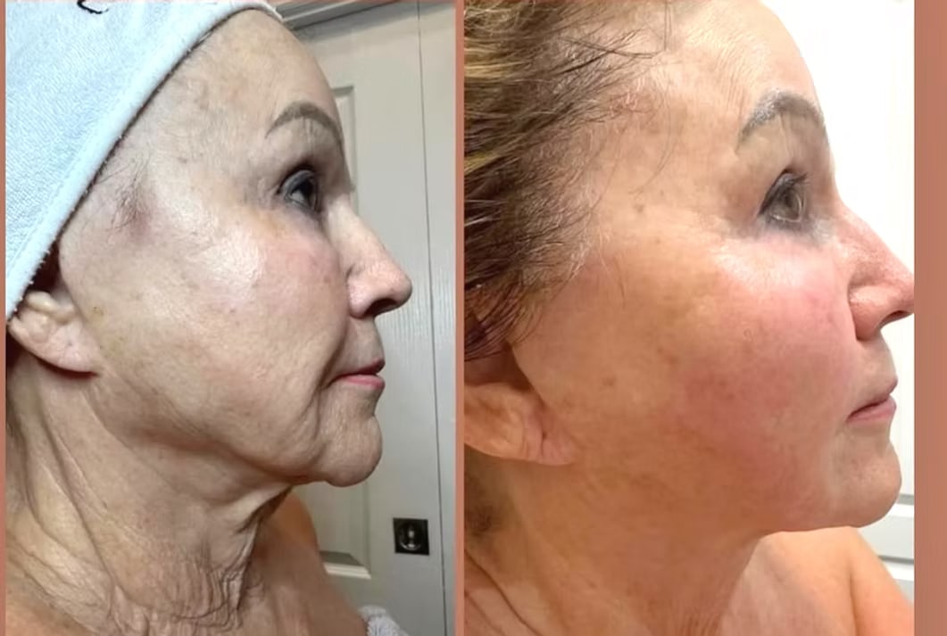 Before and after photo showing jawline and neck skin tightening results