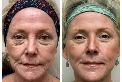Before and after photo showing jawline and neck skin tightening results